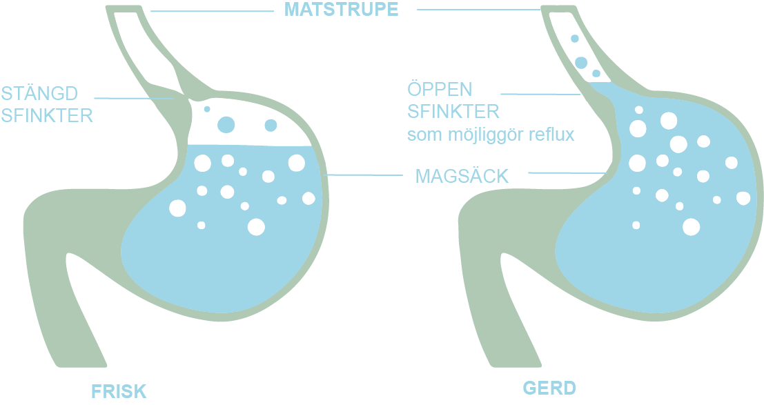 Matstrupe